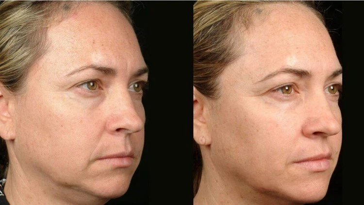 1920nm laser treatment Aging Skin 1920nm laser treatment Aging Skin